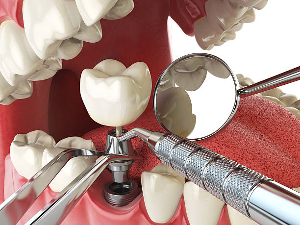 Best Emergency Treatment for Dental Infections or Abscesses in Hemet, CA